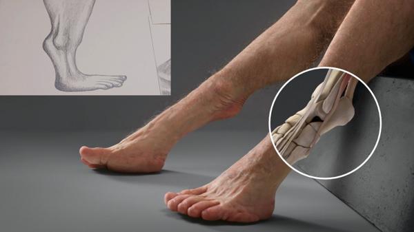La nueva articulación en las piernas (TAC)