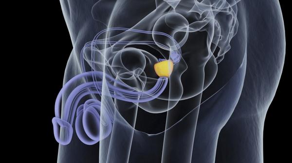 La detección temprana del cáncer de próstata ha permitido un estudio de su tratamiento (Getty)