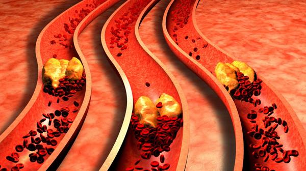La obstrucción de una arteria provoca el grave problema de salud (Istock)