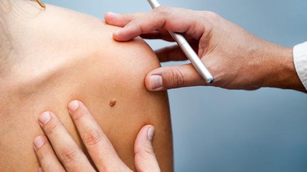 Examinar lunares y verrugas es un gran método de prevenir el avance de un melanoma (iStock)