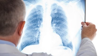 Un punto importante a tener en cuenta son las secuelas respiratorias que se presentan en los pacientes con COVID-19 (Shutterstock)
