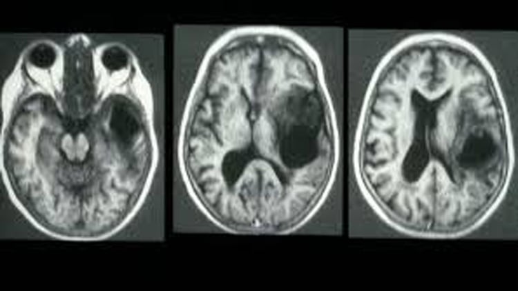 El ataque tumoral en el cerebro actúa en forma muy veloz