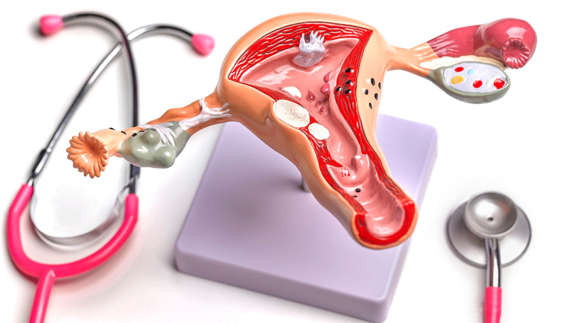 Según Mayo Clinic, "cuando aparece el cáncer de ovario, podría no causar ningún síntoma notorio" / (Getty Images)