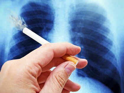 El 87 por ciento de los casos de cáncer de pulmón son a causa del cigarrillo (iStock)