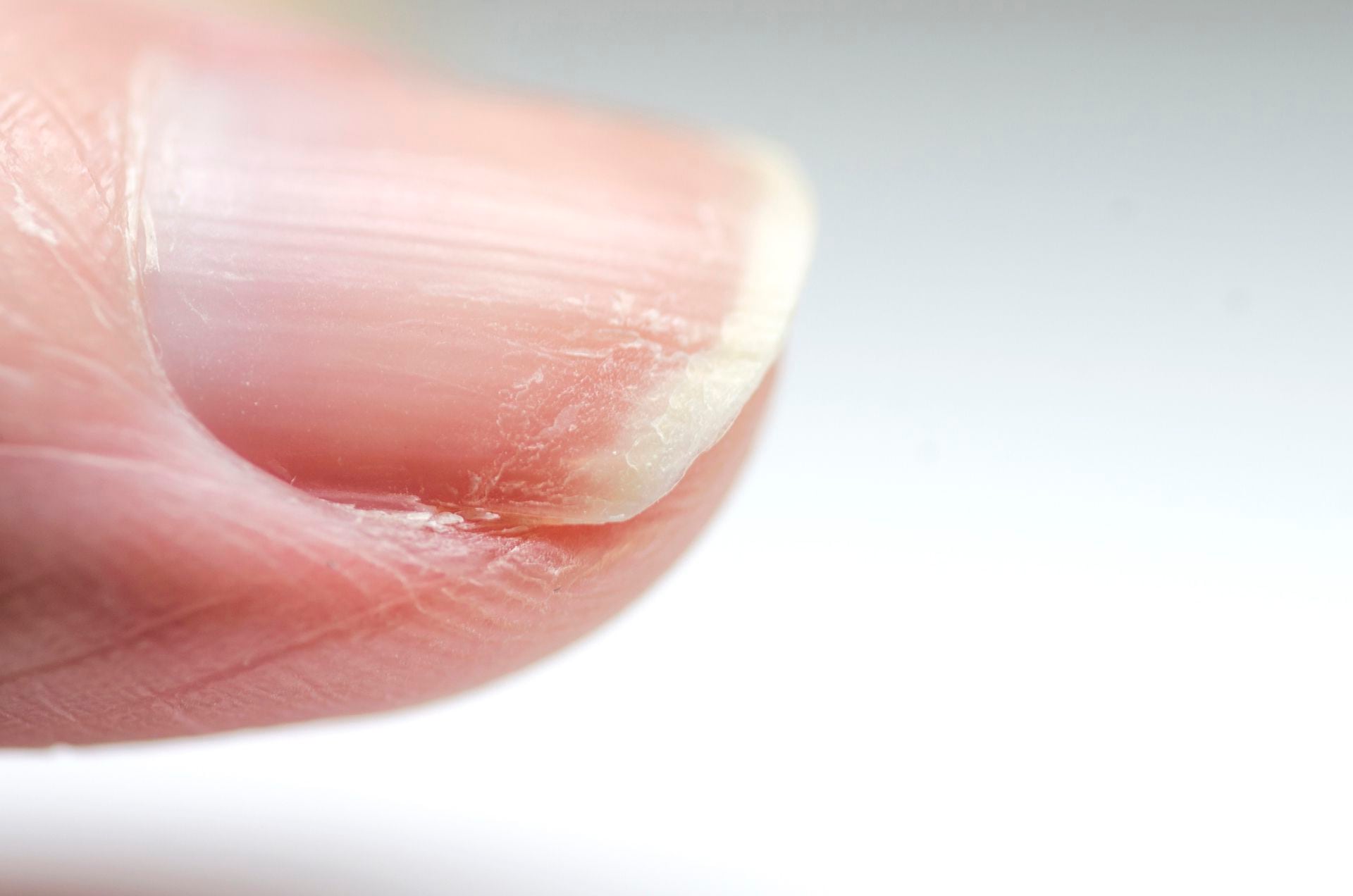 Así lucen las uñas quebradizas y con daño después de usar esmalte de forma reiterada (por la utilización de quitaesmalte de manera repetitiva)
Crédito: Getty