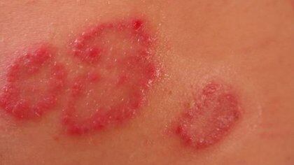 Los primeros síntomas son lesiones en la piel. (Foto: Pixabay)