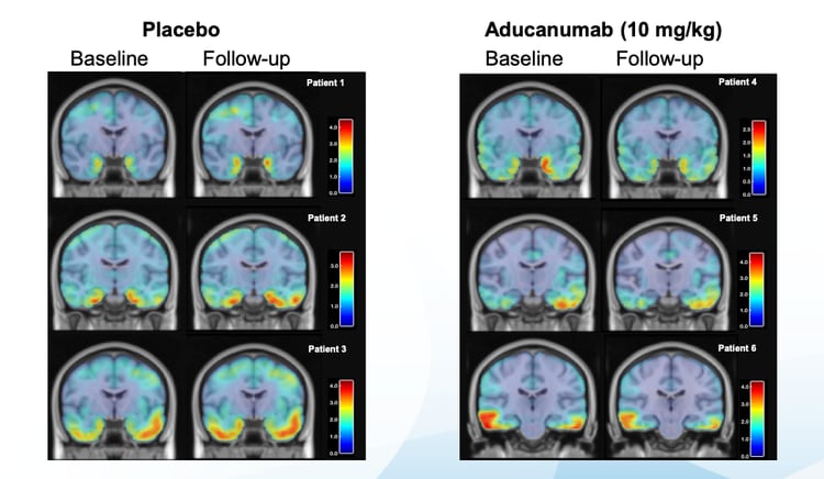 Imágenes del estudio: en los pacientes tratados con placebo (izq.) no hubo mejora, al contrario; en los tratados con aducanumab (der.) desde el primer registro hasta el último se produjo una reducción en las placas del Alzheimer. (Biogen)