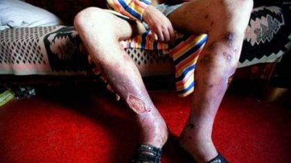 El uso de krokodile provoca severas heridas en la piel de los consumidores (Foto: Archivo)