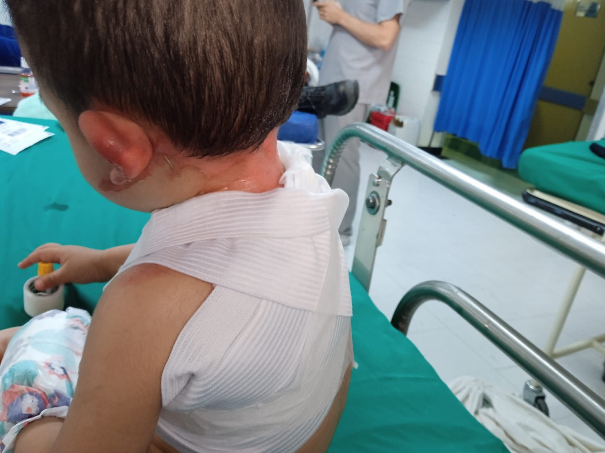 Caso di ustioni nel giardino di Bogotá Oso de Anteojos, Colombia