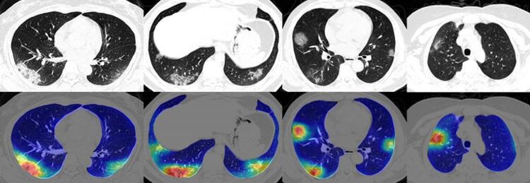 RADLogics desarrolló un algoritmo que identifica las anormalidades que causa el COVID-10 en los pulmones y pidió una autorización de emergencia a la FDA. (RADLogics)