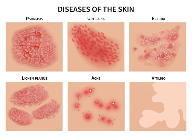 Lesiones en la piel, distintas a las psoriasis