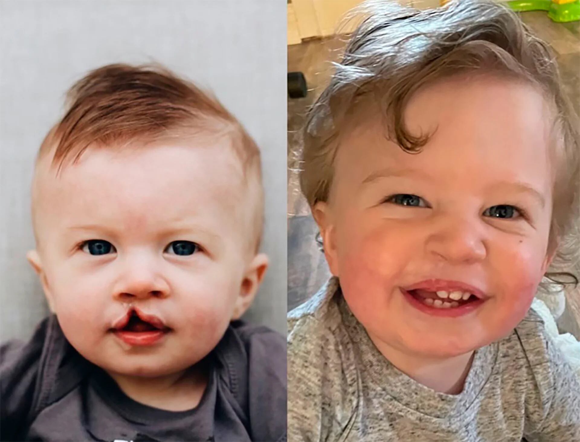 El antes y después de un niño tras ser operado por fisura de labio y paladar (foto: ONG Smile Train) 