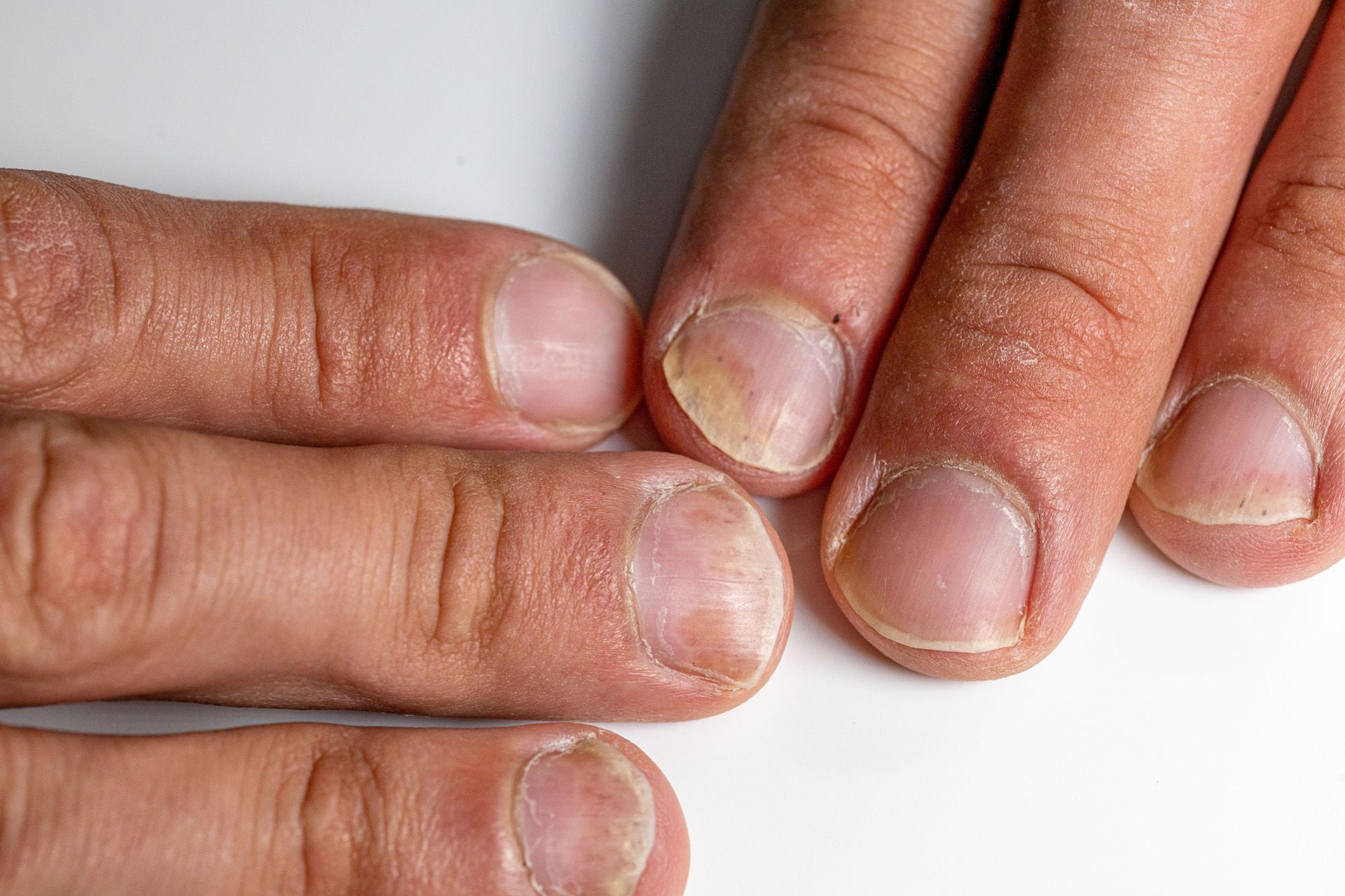 Primer plano de los dedos de un paciente con onicodistrofia psoriásica o enfermedad de las uñas psoriásica
Crédito: Freepik