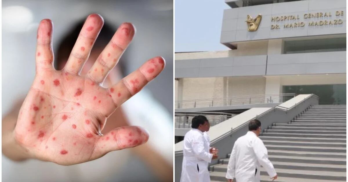 The Ministry of Health has reported 51 cases of monkeypox in the past 14 days