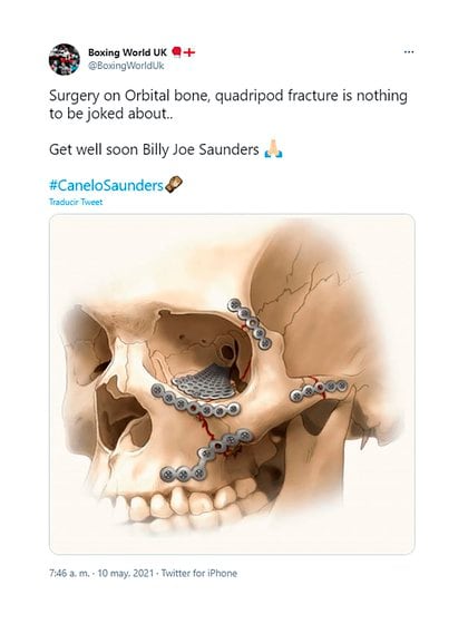 "Cirugía en el hueso orbitario, fractura de cuadrípode no es nada para bromear. Que te mejores pronto Billy Joe Saunders", publicó la cuenta BoxingWorldUk para ejemplificar las lesiones que tuvo el británico