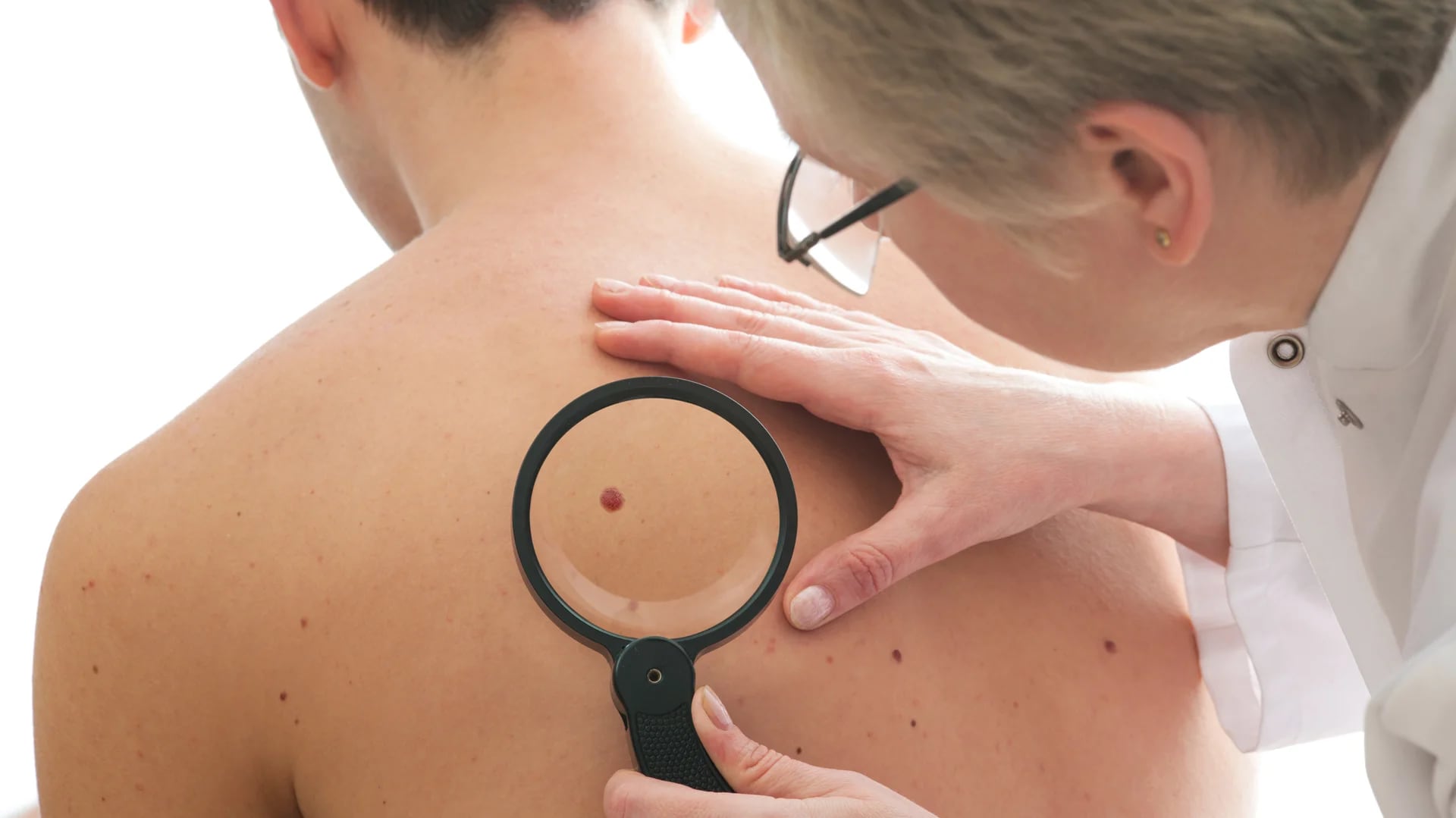 Los lunares son fundamentales en la detección de un melanoma (iStock)