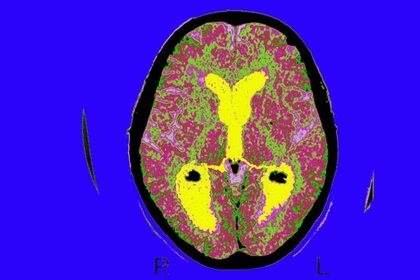 Una exploración del cerebro de un paciente afectado por la enfermedad de Alzheimer. Solo unos pocos medicamentos están aprobados para controlar los síntomas de la enfermedad de Alzheimer y no hay ninguno para tratar la causa.

