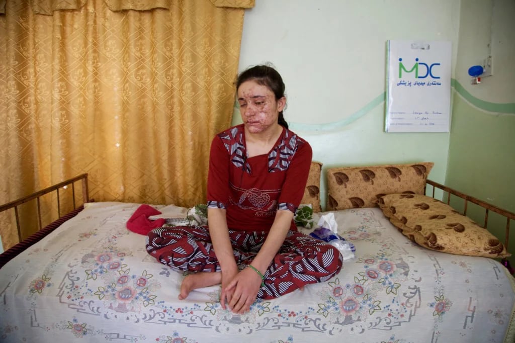 Lamiya Aji Bashar, una joven yazidí de 18 años que perdió un ojo al escapar del grupo yihadista (AP)