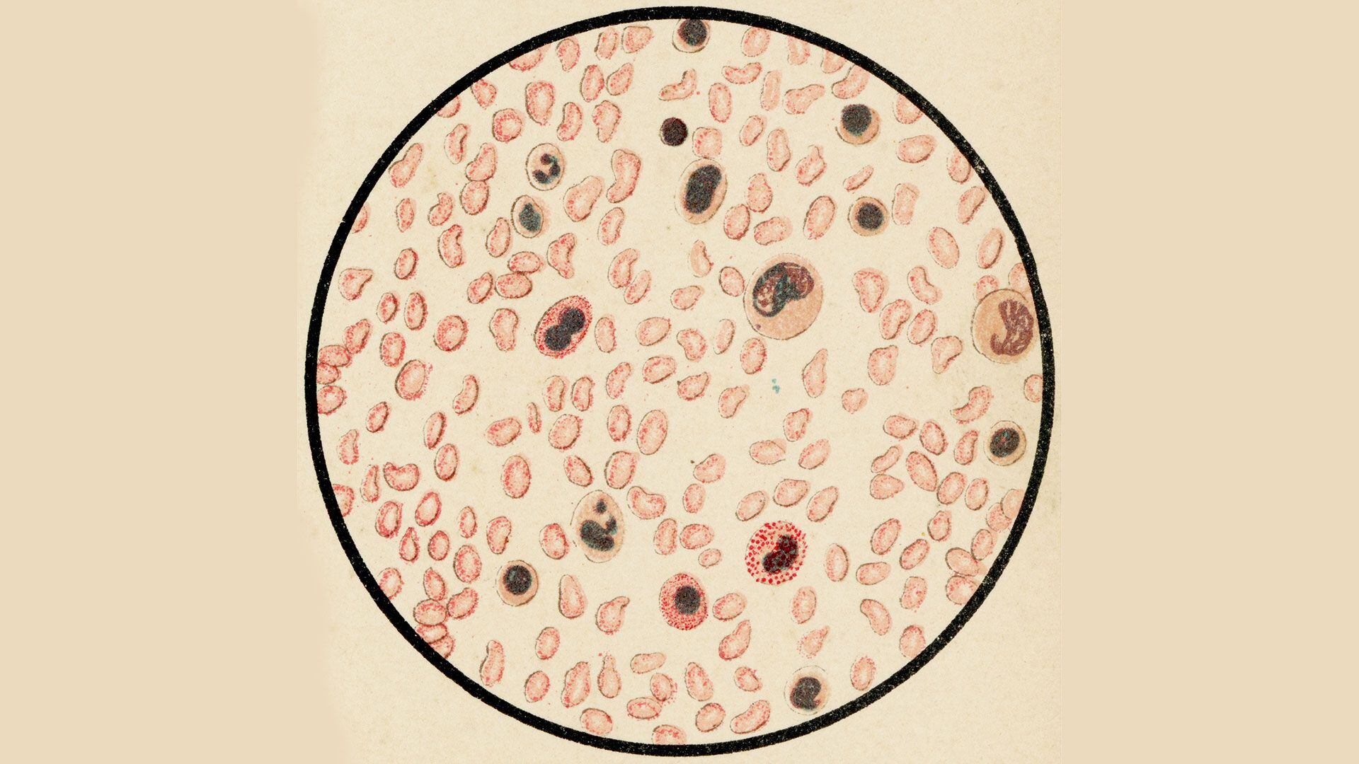 Leucemia