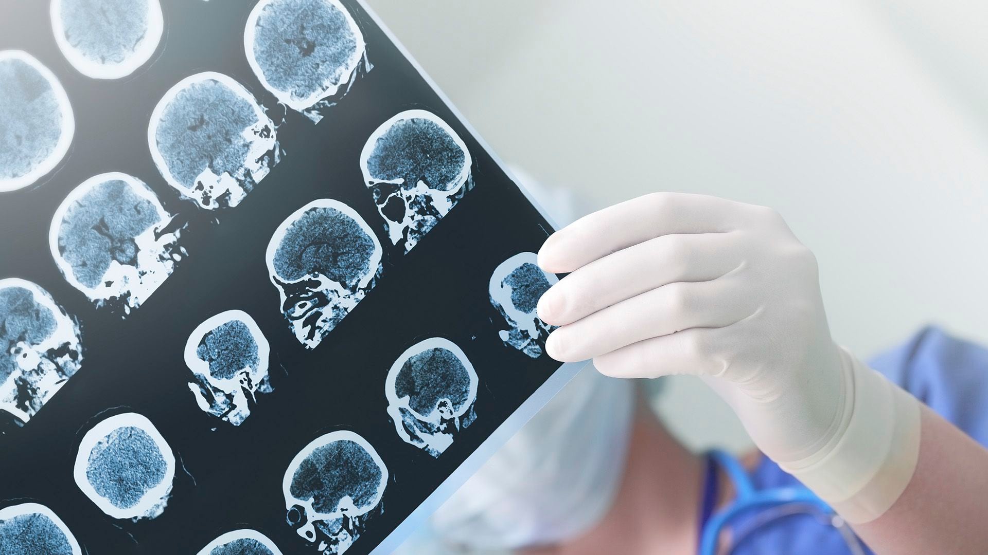 Los resultados del estudio muestran que la vacuna SAGP redujo significativamente los depósitos de amiloide en el tejido cerebral
