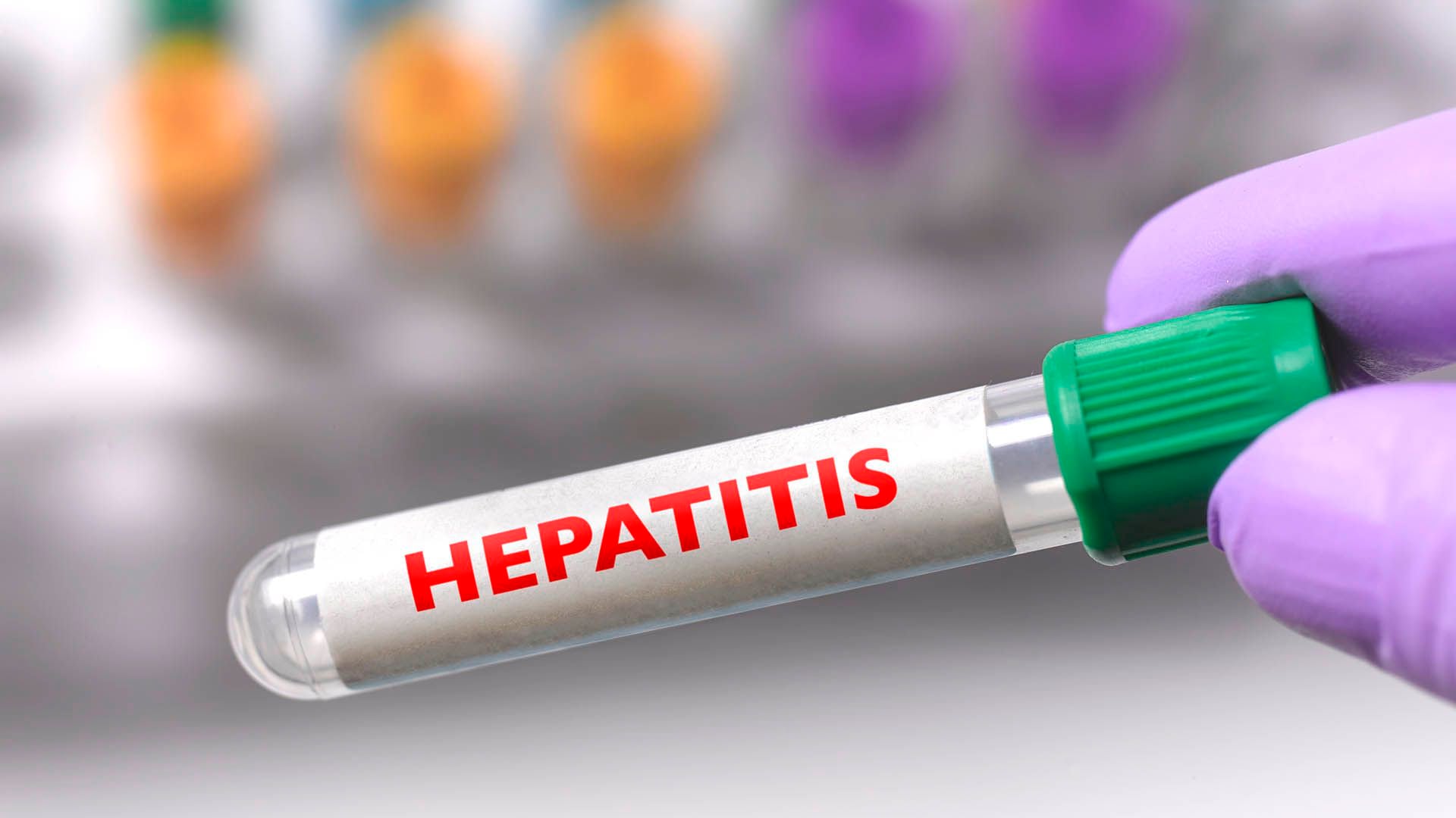 La OMS se propone para 2030 reducir en un 90% las nuevas infecciones de hepatitis B y C y en un 65% los cánceres de hígado y la cirrosis (Getty Images)