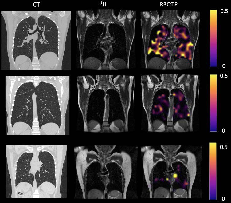 CAPTION Example CT, proton, proton and RBC:TP imaging from post-Covid-19 condition participants. The top row is a participant with RBC:TP = 0.49, the middle row is a participant with RBC:TP of 0.31, and the bottom row is a participant with RBC:TP = 0.24. Imaging showed little to no discernible damage on CT, and yet highly heterogeneous and low RBC:TP in the lungs of non-hospitalized post-Covid-19 condition participants. RBC:TP = Hyperpolarized 129Xenon MRI lung ratio of red blood cell spectral peak to tissue phase spectral peak  CREDIT Radiological Society of North America
