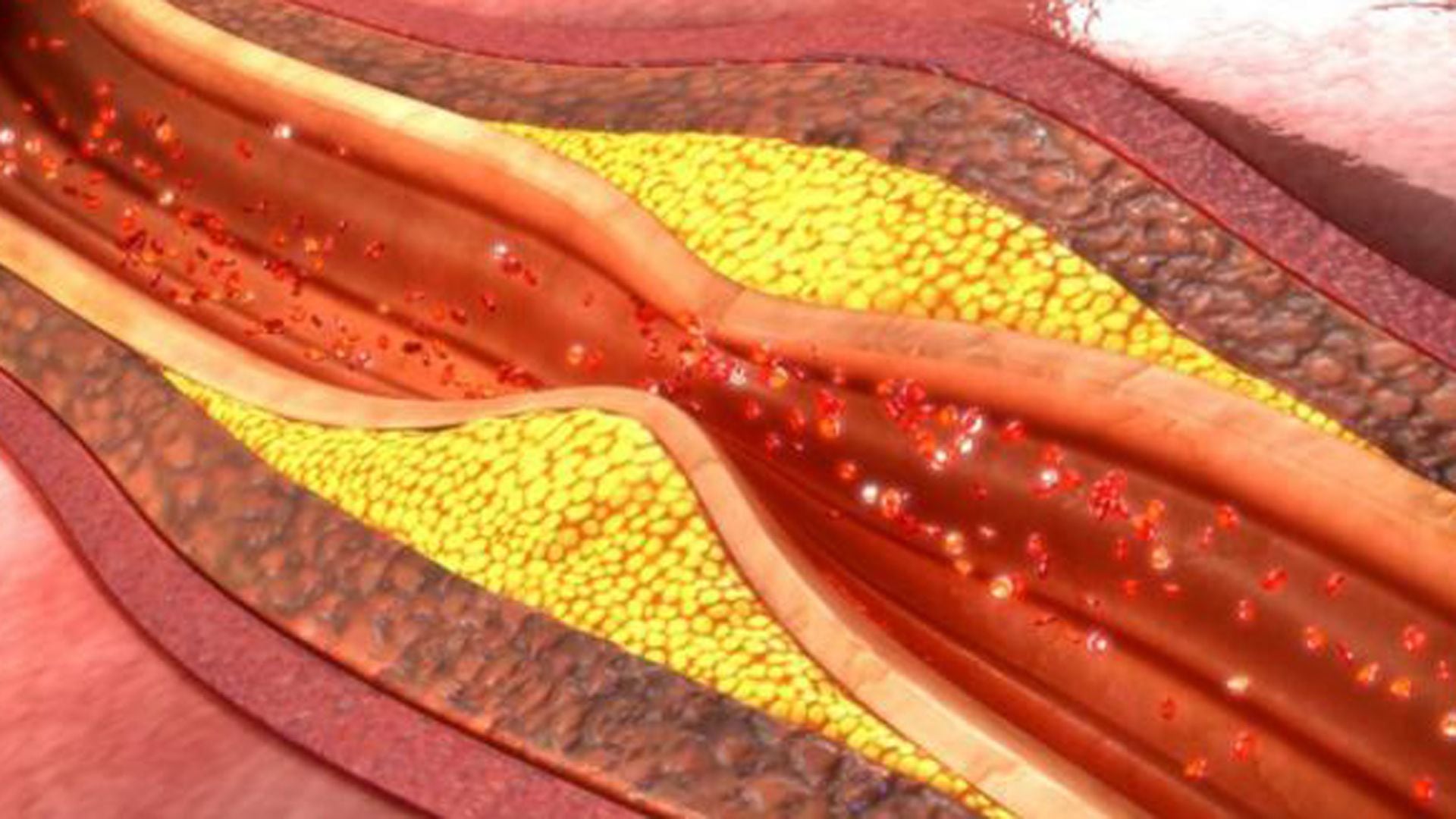 La rotura de la placa  aterosclerótica puede generar un infarto del corazón, un ataque cerebrovascular, la demencia vascular, la disfunción eréctil o pérdida de una de las piernas o de los brazos