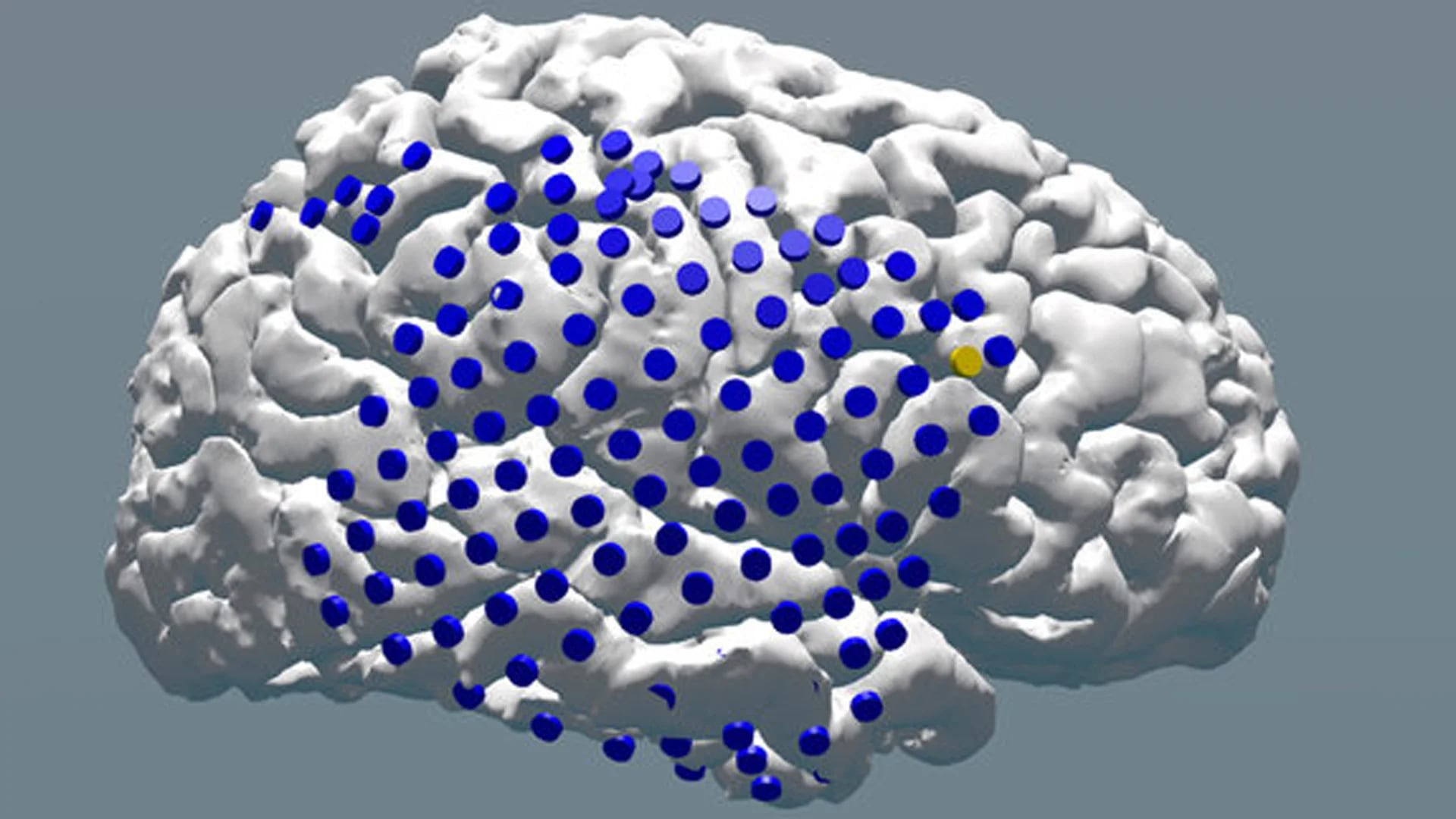 En el hemisferio derecho del cerebro de un participante del estudio, los electrodos se superponen en azul y el objetivo para la estimulación se ve resaltado en amarillo (Joel Stein and Youssef Ezzyat)