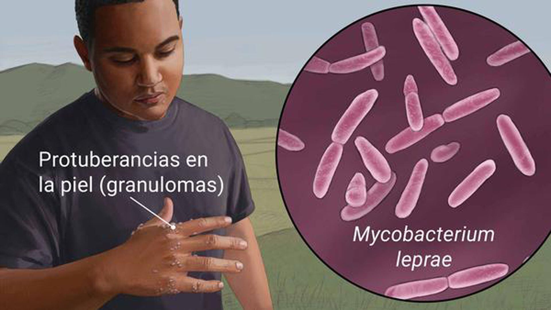 La lepra puede generar manchas claras u oscuras en la piel y entumecimientos. Es una de las enfermedades desatendidas (OMS)