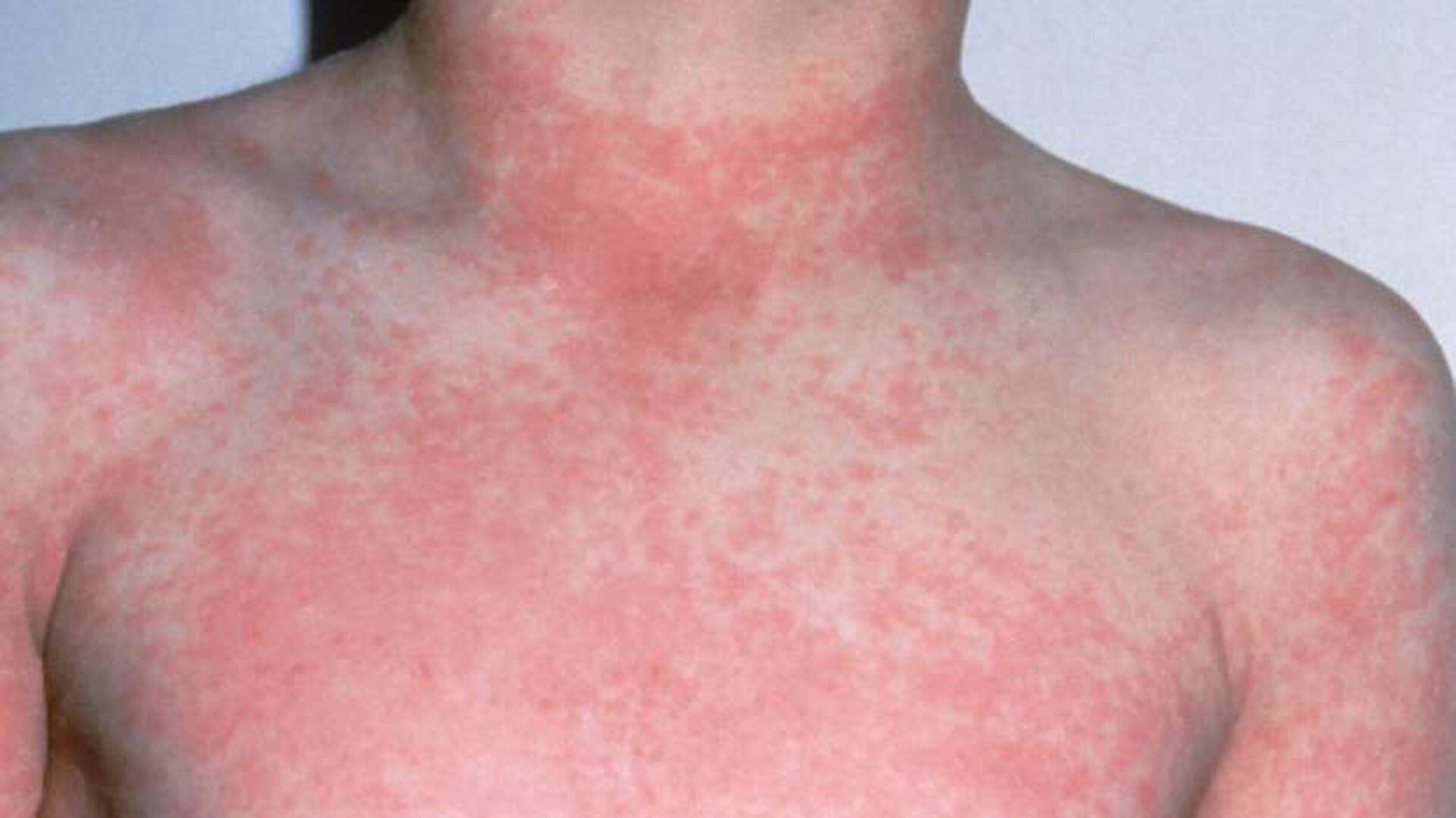 El principal síntoma de la escarlatina  es la presencia de pequeñas lesiones rojas puntiformes que se atenúan al presionar la piel y son ásperas al tacto (SMG Center)