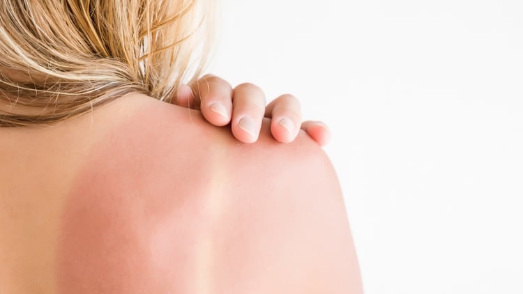 Las personas cuya piel se enrojece luego de una exposición solar tienen más predisposición a tener cáncer de piel (Shutterstock)