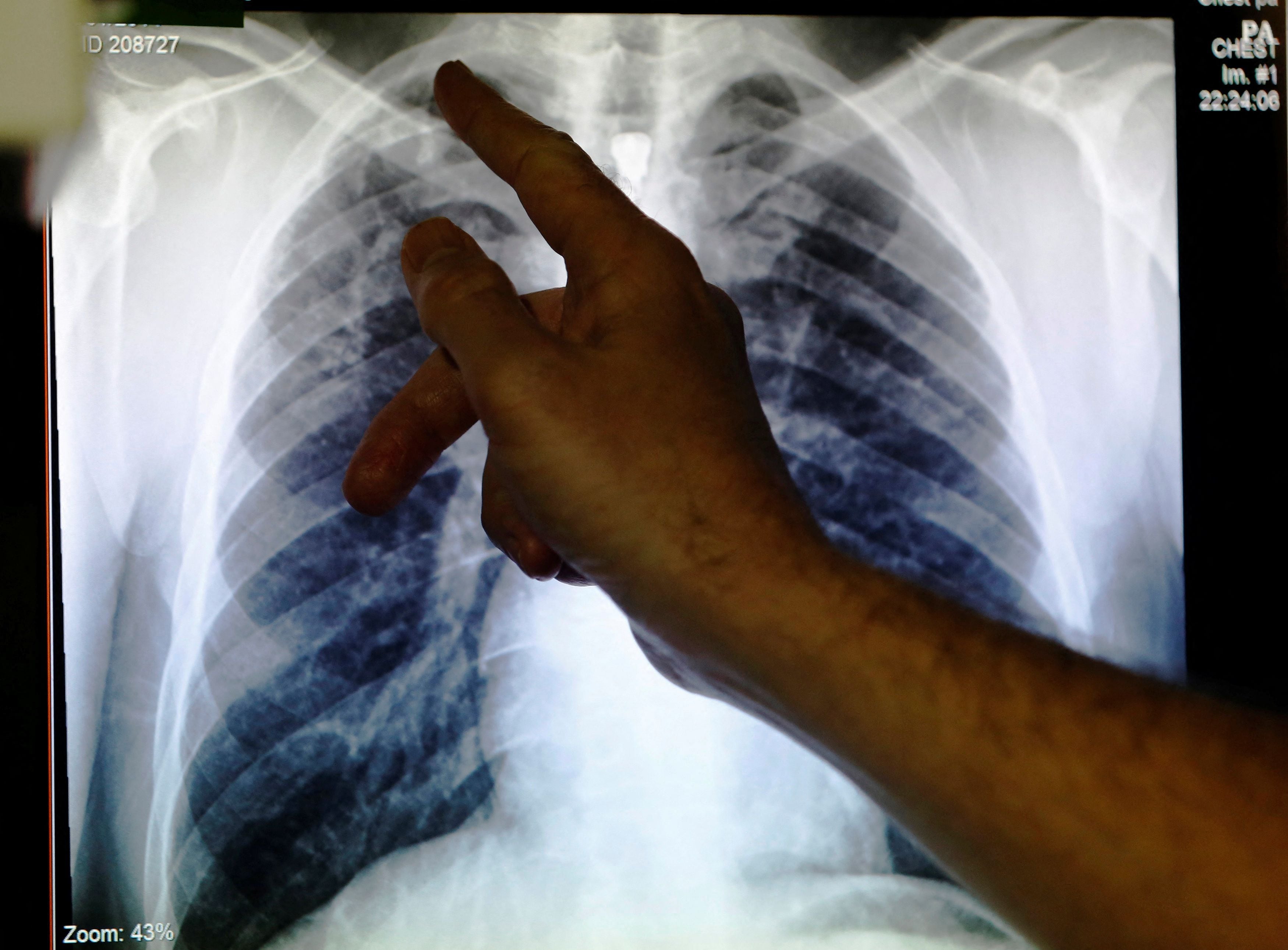 Aproximadamente cada 8 horas muere una persona en Argentina por tuberculosis (REUTERS/Luke MacGregor/File Photo)