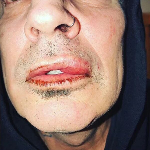 Tommy Lee acusó a su hijo Brandon de pegarle una trompada que le dejó el labio hinchado (Instagram Tommy Lee)