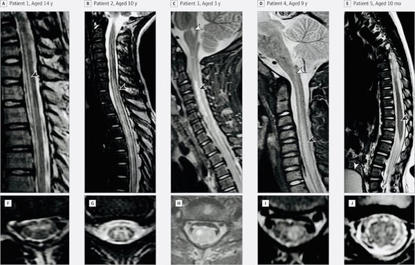 Las imágenes de resonancia magnética muestran el daño específico en la médula espinal