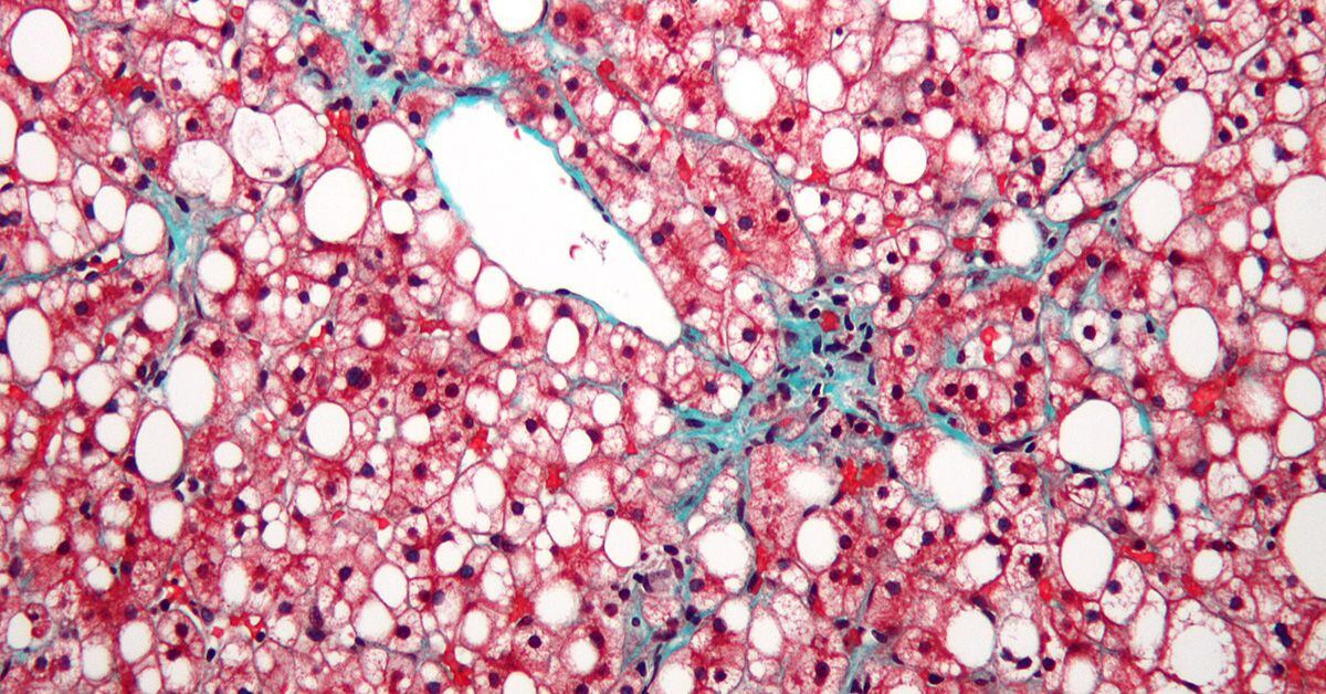 La característica principal de la NAFLD es el exceso de grasa almacenada en las células hepáticas