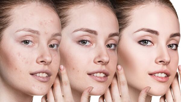 Resultado de imagen para mitos sobre el acne, arcilla y cebolla