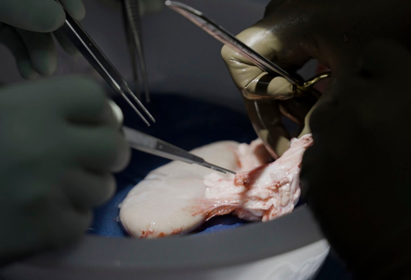 Cirujanos en el centro médico Langone Health de la Universidad de Nueva York se preparan para trasplantar el riñón de un cerdo a un hombre con muerte cerebral en Nueva York, el 14 de julio de 2023. (AP Foto/Shelby Lum)