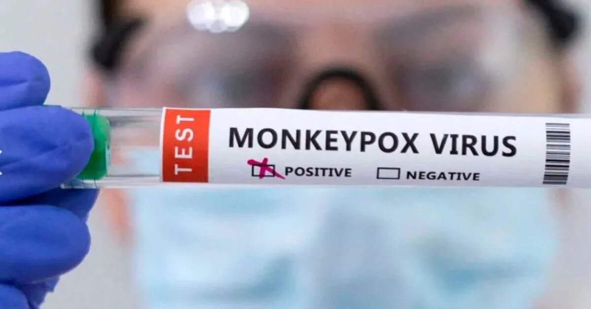 Viruela del mono: Confirman primera muerte a causa de este virus en el Perú