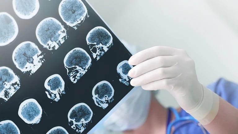  El Hospital General de Massachusetts desarrolló recientemente un método preciso para la detección de Alzheimer que se b 