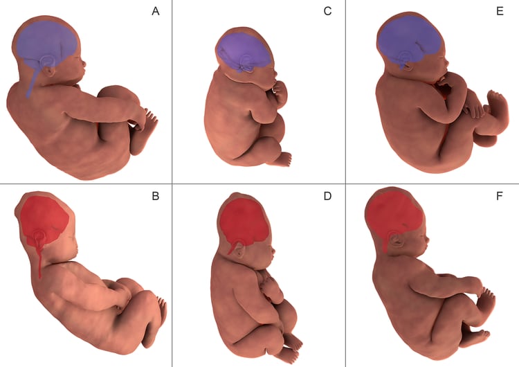 La reconstrucciÃ³n tridimensional de la resonancia cerebral fetal muestra la forma del cerebro de un bebÃ© antes de parto (en morado en las imÃ¡genes A, C y E) y durante la segunda etapa del parto (en naranja en las imÃ¡genes B, D y F). Olivier Amie and co-authors, CC BY
