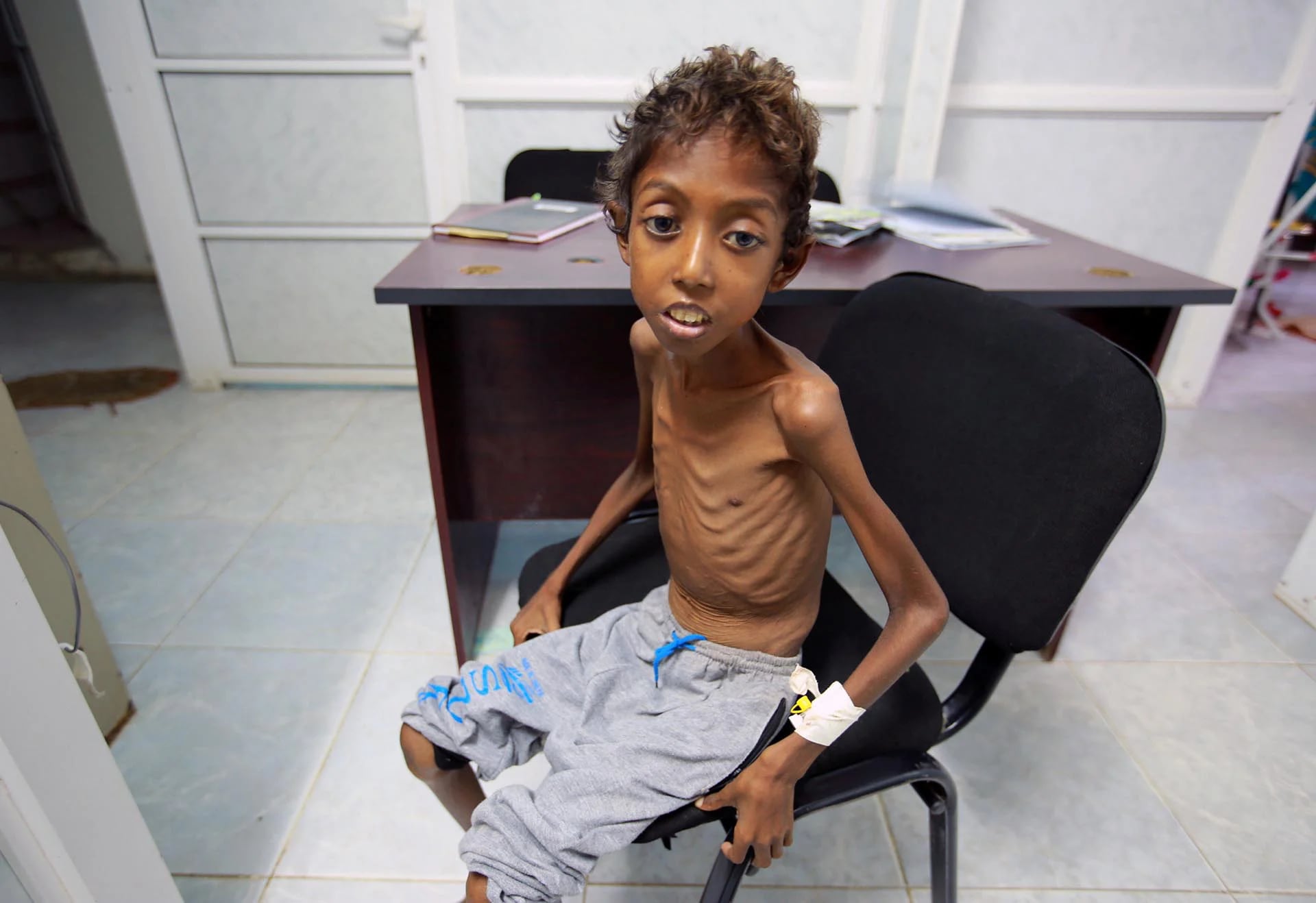Imran Faraj, de 8 años de edad, que sufre de malnutrición en un hospital en la ciudad portuaria de Hodeidah, Yemen