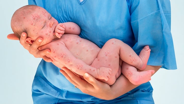 El rango de edad en los casos confirmados de sarampión va de 2 meses a 61 años. Los menores de 1 año registran la tasa más alta de incidencia, seguido de niños de 1 a 4 años (Shutterstock)