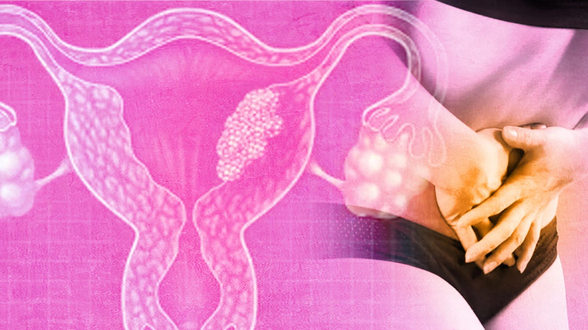 Para que ser mujer no duela: por qué era necesaria una ley sobre la endometriosis en Colombia 