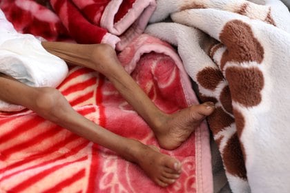 Una niña desnutrida en el hospital al-Sabeen de Sanaa, Yemen (REUTERS/Khaled Abdullah)