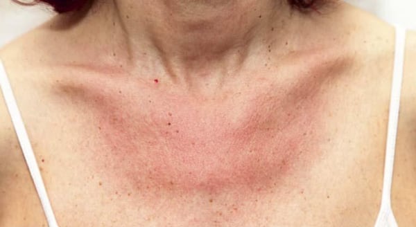 Alergia por tomar sol y reacción en la piel