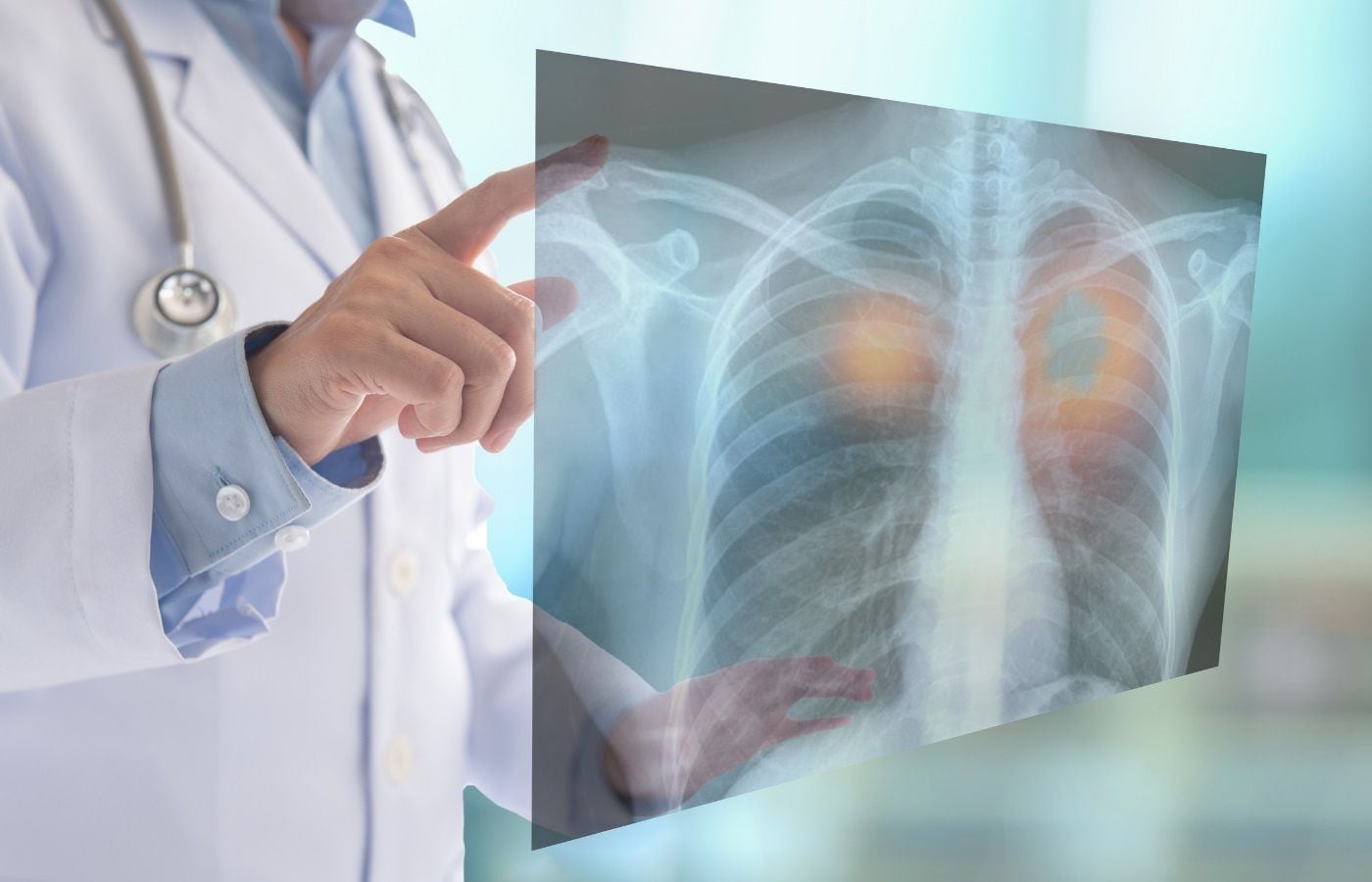 Radiografía de un pulmón. (Europa Press)