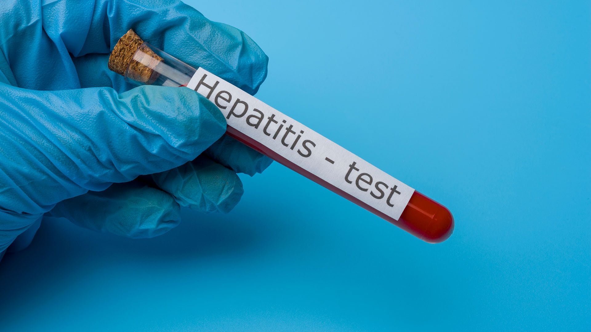 Los expertos de la SAHE advirtieron sobre los riesgos de no diagnosticar a tiempo la hepatitis C