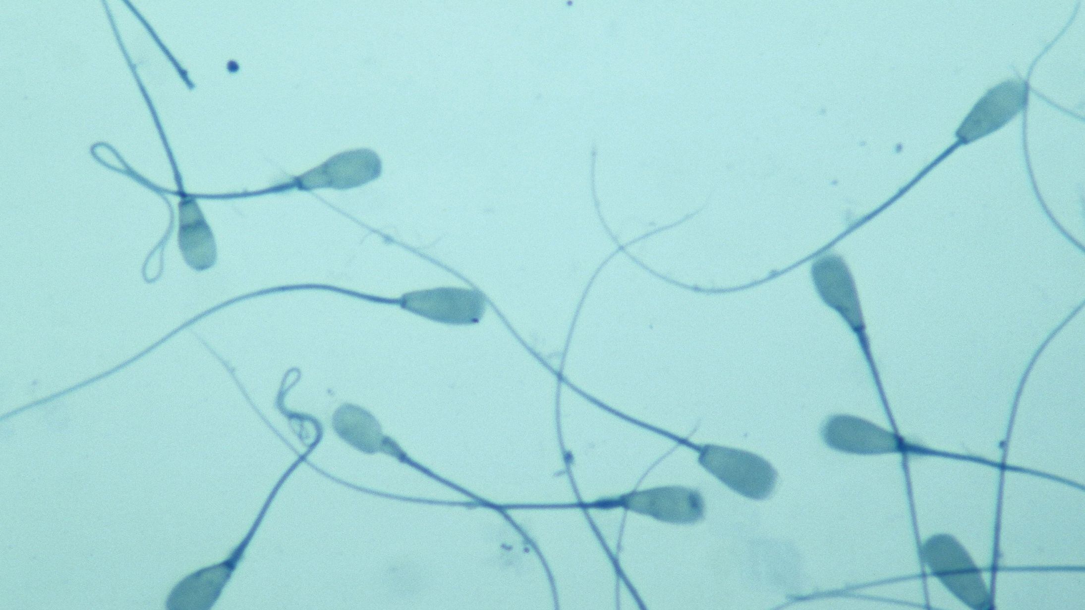 La enfermedad del SARS-CoV-2 podría afectar a la fertilidad de los hombres, según recientes investigaciones (Getty Images)