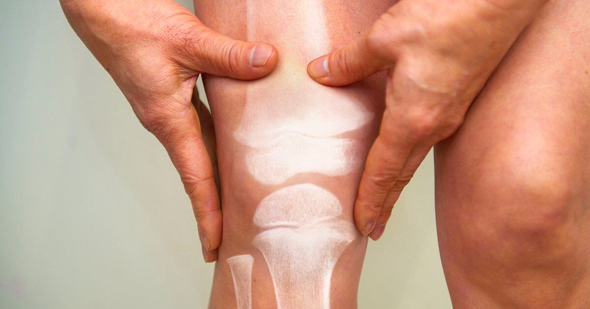 Día Mundial de la Osteoporosis: Advierten que el infradiagnóstico es muy alto en pacientes con fracturas