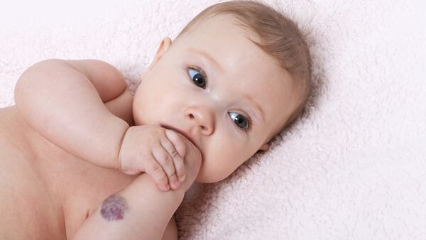No se deben confundir los hemangiomas infantiles con las malformaciones vasculares (Getty Images)